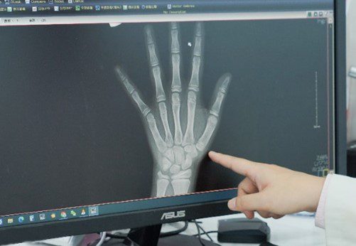 手部Ｘ光可以看到手指、手掌、手腕的生長板，需持續追蹤半年至一年以上的時間，觀察骨骼及生長板的變化，才得以讓兒童內分泌專科醫師較正確的推估骨齡、進一步作為性早熟病程的完整評估或後續治療方針。(圖/禾馨提供)