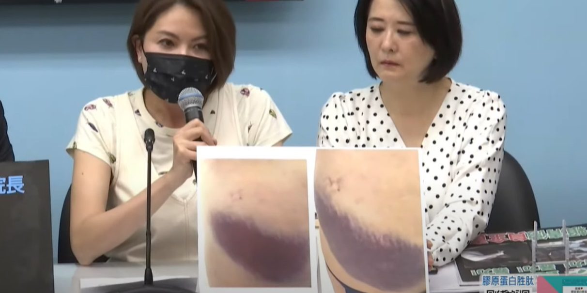 陳菁徽痛哭曝傷勢照片!臀部、腰部遭鍾佳濱魔爪「超大片瘀青」怵目驚心 陳菁徽痛哭曝傷勢照片!臀部、腰部遭鍾佳濱魔爪「超大片瘀青」怵目驚心