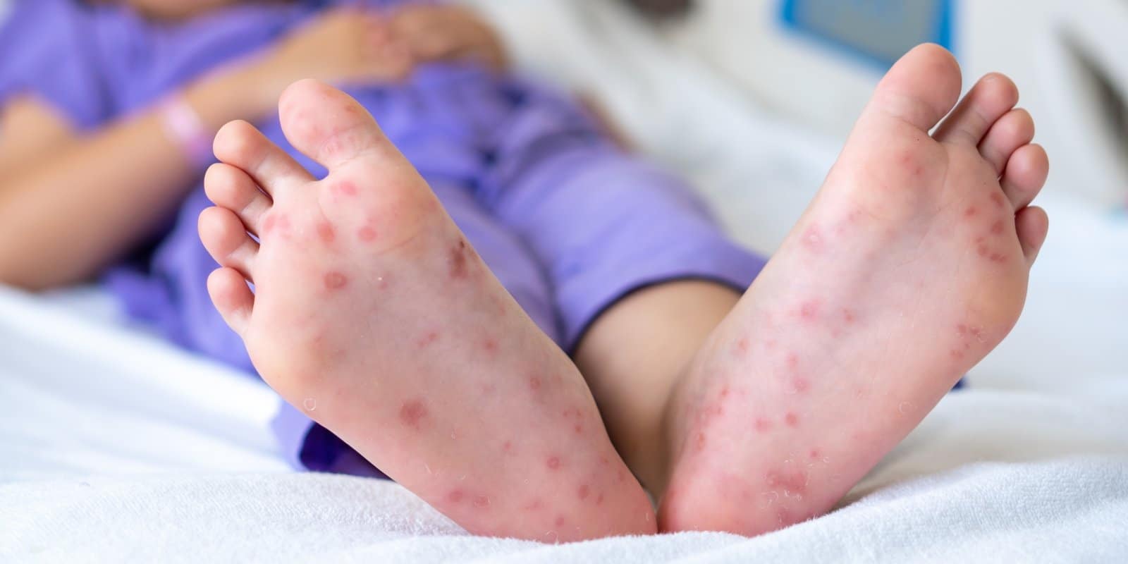 腸病毒症狀詳解：大人兒童初期症狀、多久會好、潛伏期、停課標準