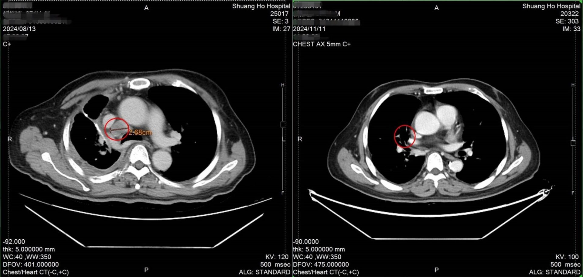 雙和醫院治癌新突破！DC-CIK細胞療法助癌末病患脫困