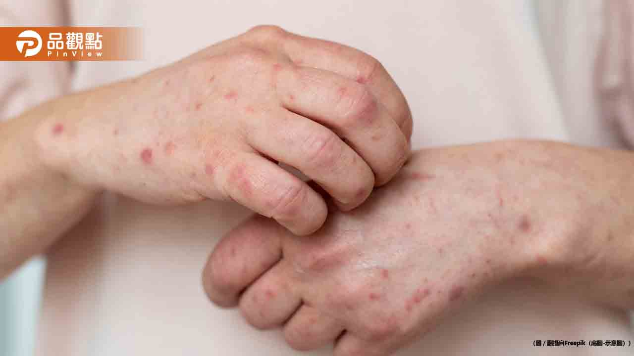 麻疹疫情要爆發了!接觸者破3000人 創5年新高 麻疹疫情要爆發了!接觸者破3000人 創5年新高