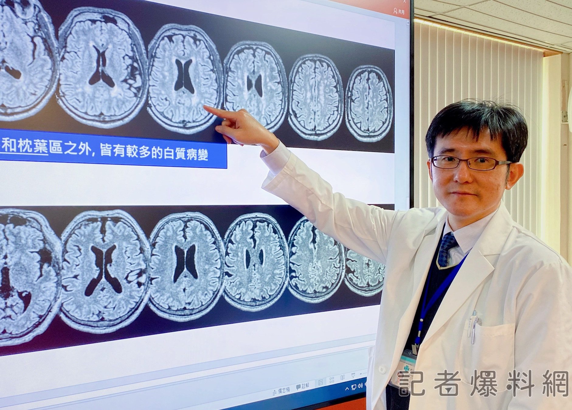 台中榮總研究發現台灣人特有的基因變異 年輕即可能造成腦病變 台中榮總研究發現台灣人特有的基因變異 年輕即可能造成腦病變