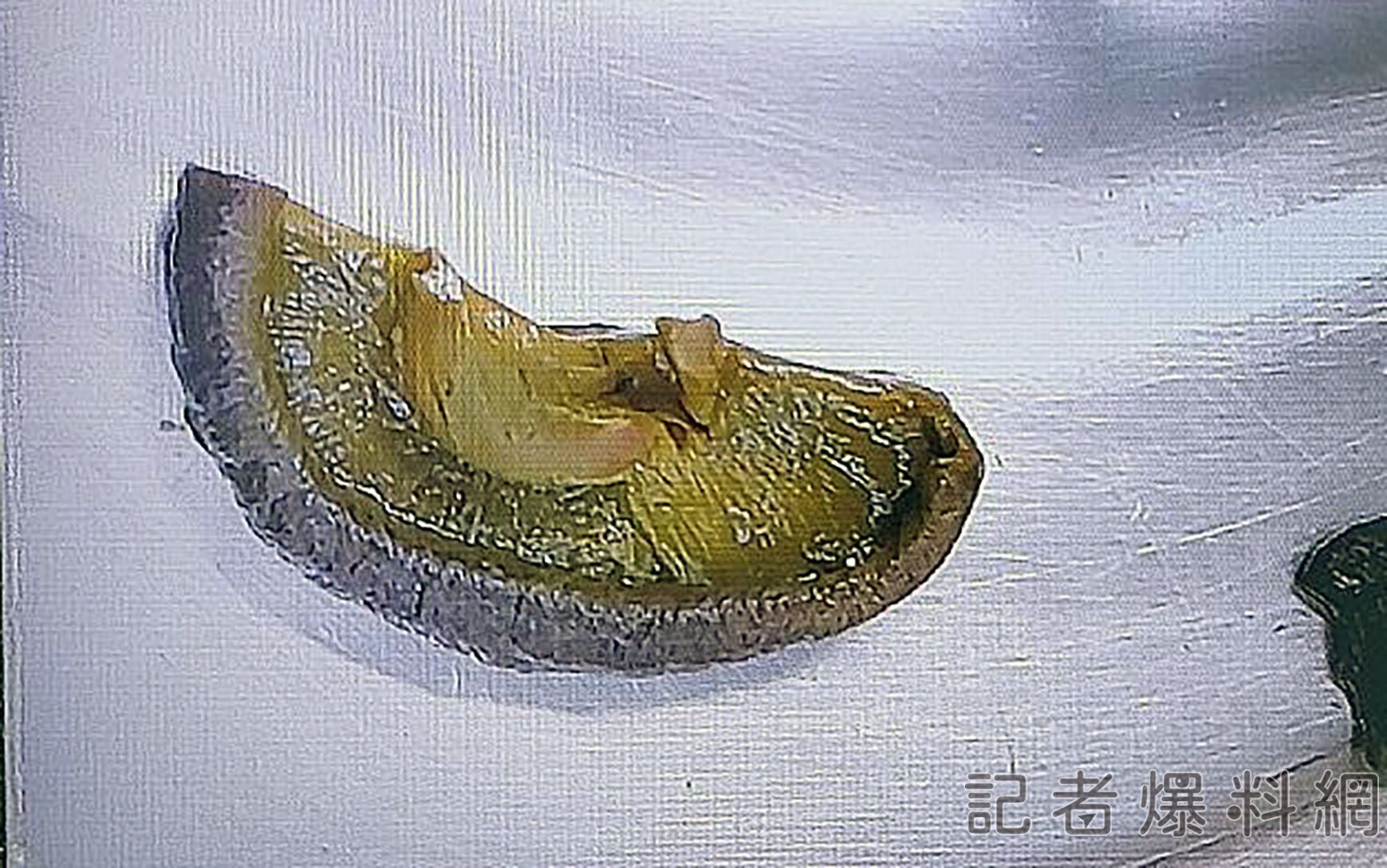台中男滿口爛牙進食沒咬碎  5公分香菇卡小腸
