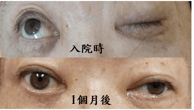 不是中風!眼睛張不開 北榮桃園分院診斷是這疾病導致 不是中風!眼睛張不開 北榮桃園分院診斷是這疾病導致