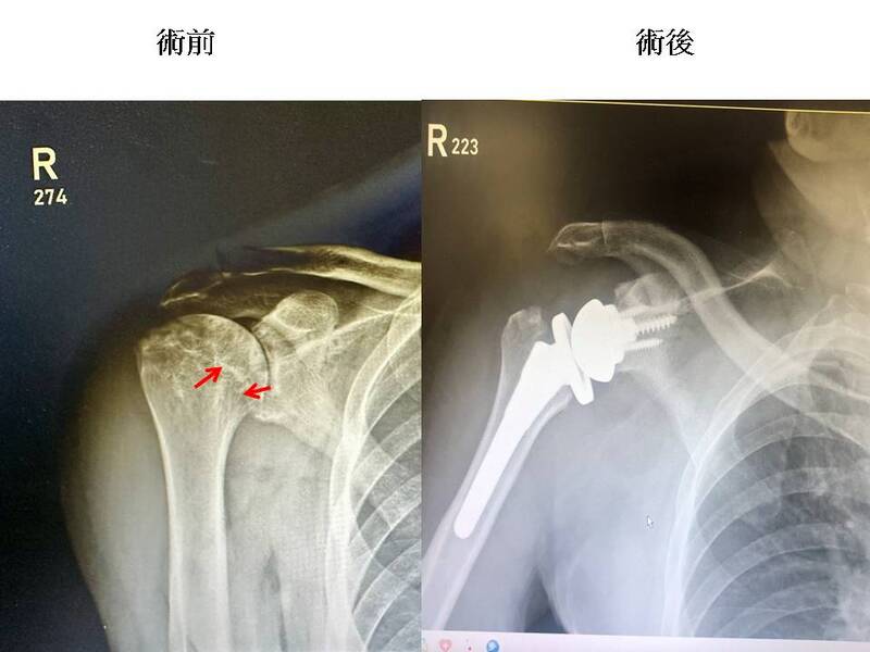 反置肩關節換術創奇蹟  八旬翁重燃網球冠軍夢 反置肩關節換術創奇蹟  八旬翁重燃網球冠軍夢