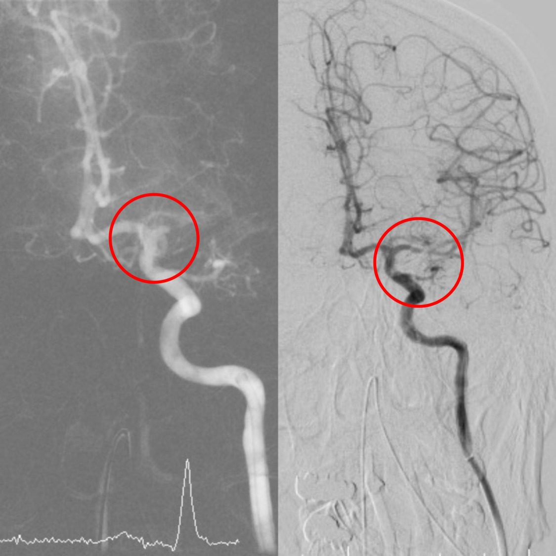 小港醫院強化急重症醫療 取栓團隊黃金時間搶救腦中風 小港醫院強化急重症醫療 取栓團隊黃金時間搶救腦中風