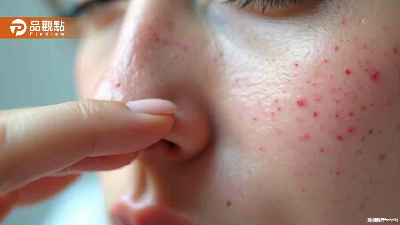 30歲女突然大爆痘崩潰!醫師:不是青春痘是「這病因」 30歲女突然大爆痘崩潰!醫師:不是青春痘是「這病因」