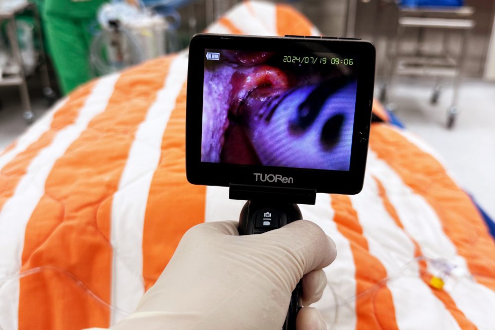 影像喉頭鏡普及 醫:提升插管安全性 影像喉頭鏡普及 醫:提升插管安全性