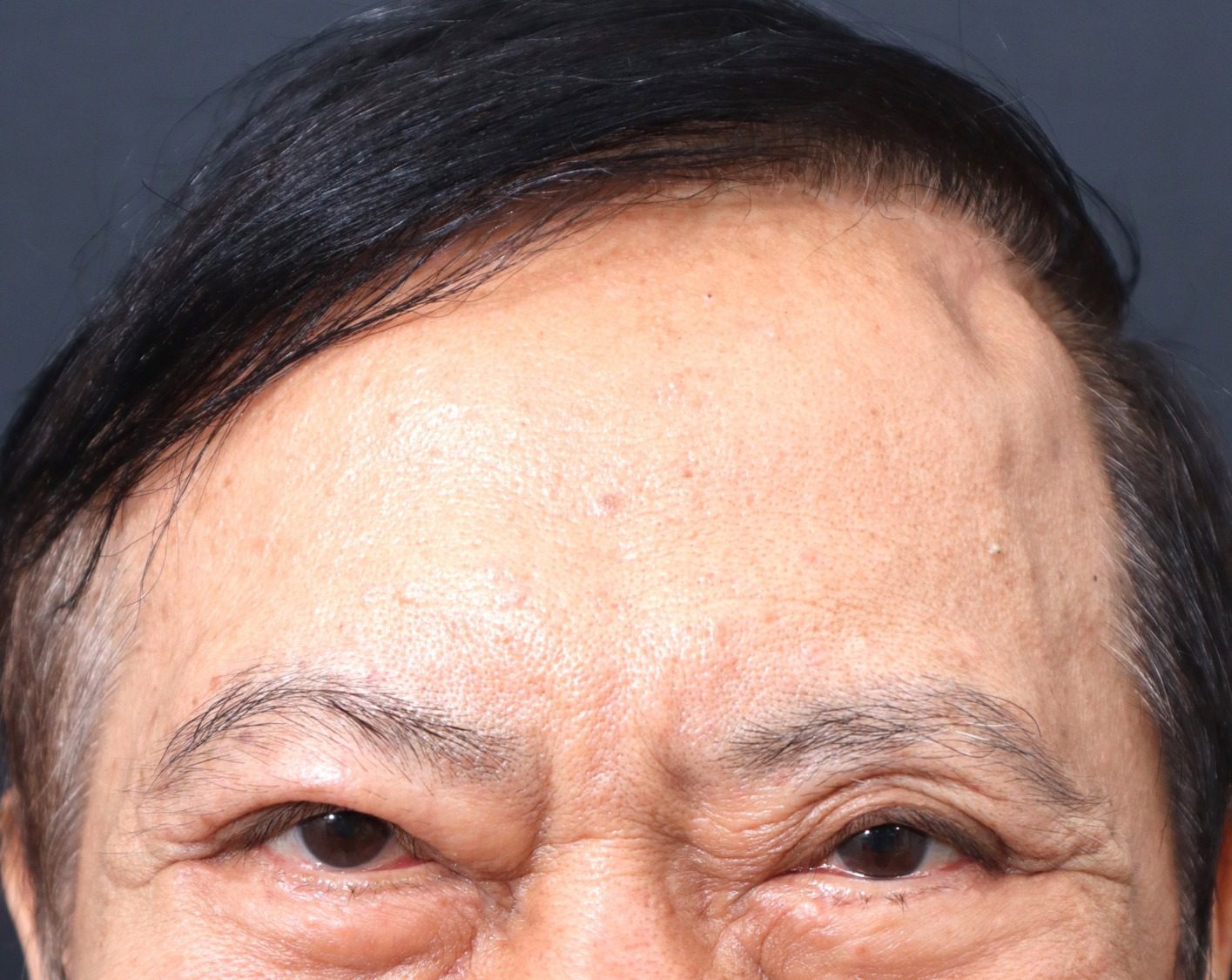 額頭拉皮還我年輕本色 資深醫師整形追夢 再創事業第二春 額頭拉皮還我年輕本色 資深醫師整形追夢 再創事業第二春