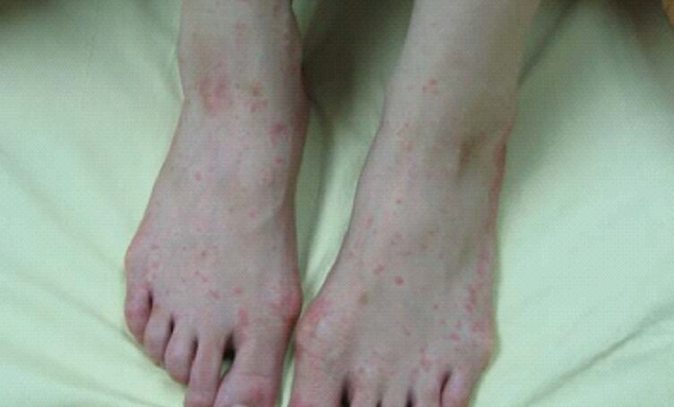 桃園首例本土麻疹現蹤!衛生局提醒去過「這地方」要注意 桃園首例本土麻疹現蹤!衛生局提醒去過「這地方」要注意
