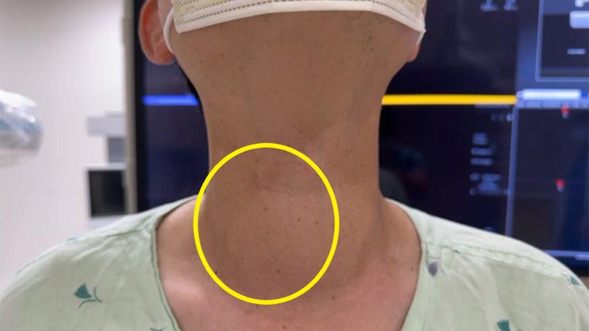 甲狀腺結節治療多元 微創技術助患者擺脫不適 甲狀腺結節治療多元 微創技術助患者擺脫不適