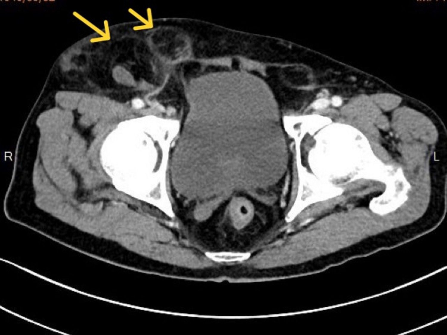 近八旬老翁竟是罕見雙疝氣 高醫岡山醫院精準腹腔鏡手術防堵保命 近八旬老翁竟是罕見雙疝氣 高醫岡山醫院精準腹腔鏡手術防堵保命