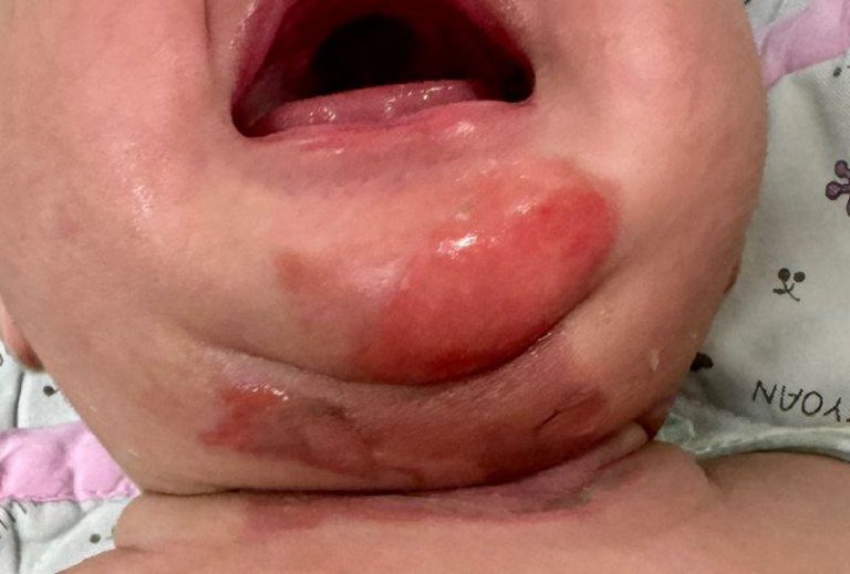 居家舒緩嬰兒鼻塞要小心! 熱水蒸氣意外燙傷滿月嬰 居家舒緩嬰兒鼻塞要小心! 熱水蒸氣意外燙傷滿月嬰