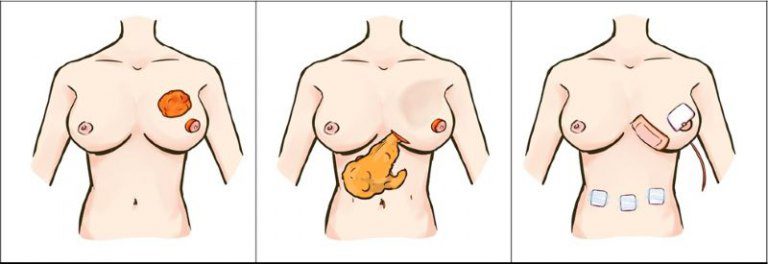 突破傳統!大網膜自體皮瓣乳房重建技術 讓乳癌病人重拾美麗與自信 突破傳統!大網膜自體皮瓣乳房重建技術 讓乳癌病人重拾美麗與自信