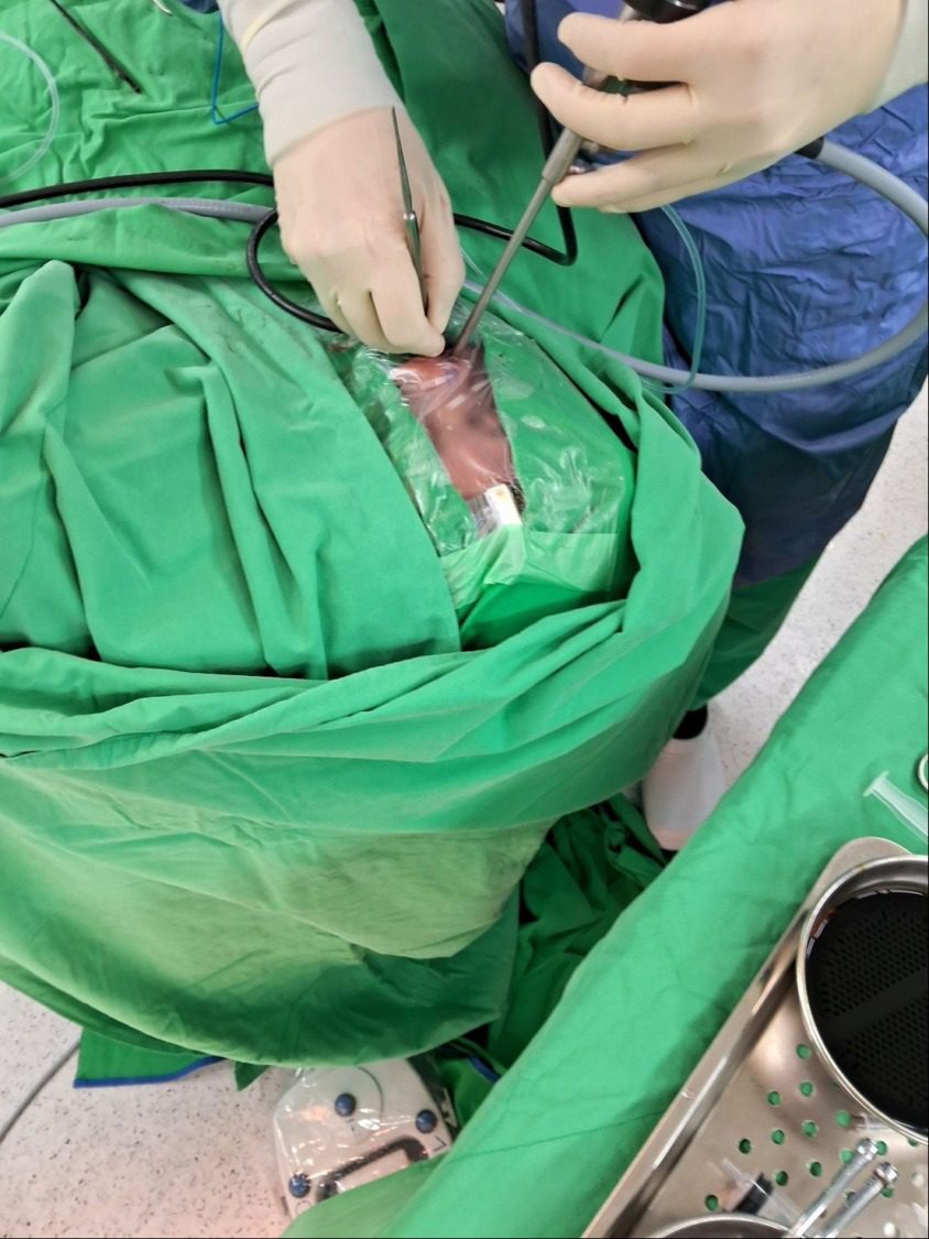 高雄秀傳紀念醫院「無痕」手術 成功攻克腦下垂體腫瘤,患者視力回神 高雄秀傳紀念醫院「無痕」手術 成功攻克腦下垂體腫瘤,患者視力回神