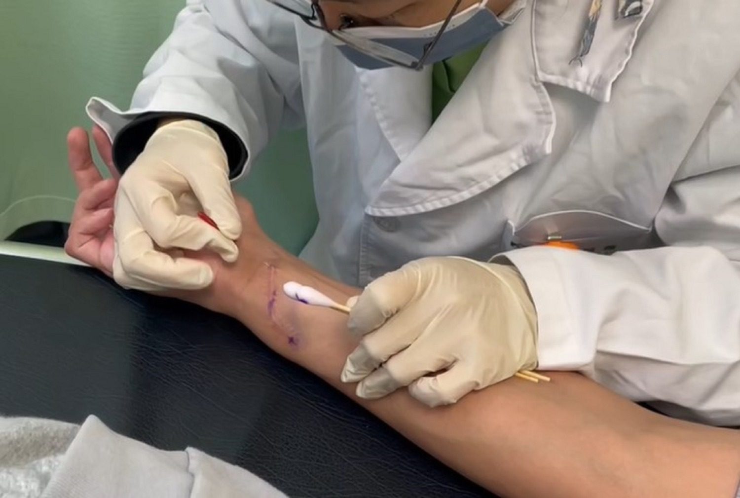 小針刀疤痕鬆解術助攻 電梯工程師傷後神經修復 「手指能動了!」 小針刀疤痕鬆解術助攻 電梯工程師傷後神經修復 「手指能動了!」