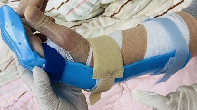 切水果割傷手指竟導致「屈指肌腱斷裂」 部桃:復健期至少需12周 切水果割傷手指竟導致「屈指肌腱斷裂」 部桃:復健期至少需12周