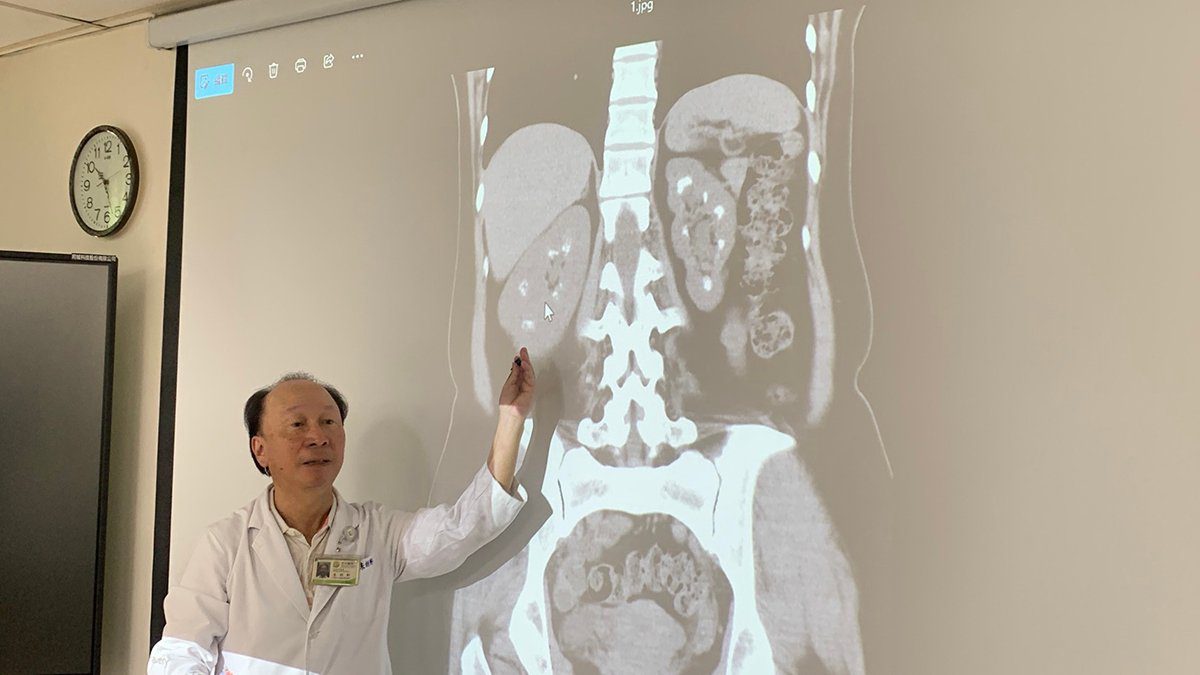她2年內5度腎結石 醫揭雙腎如「滿天星」竟與副甲狀腺有關 她2年內5度腎結石 醫揭雙腎如「滿天星」竟與副甲狀腺有關