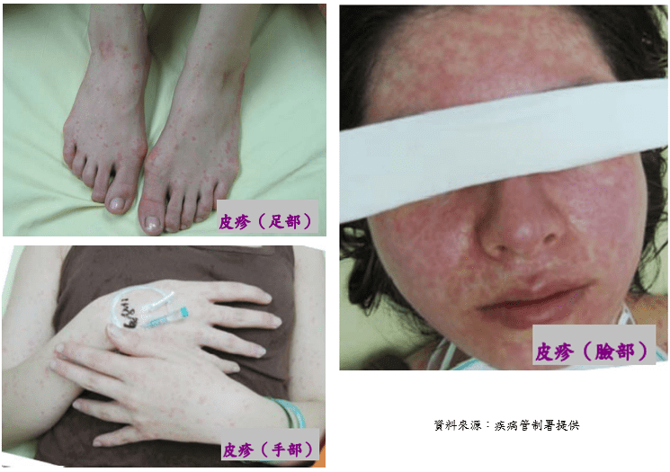 桃園麻疹確診再添2例!衛生局曝足跡 清明連假曾搭高鐵 桃園麻疹確診再添2例!衛生局曝足跡 清明連假曾搭高鐵