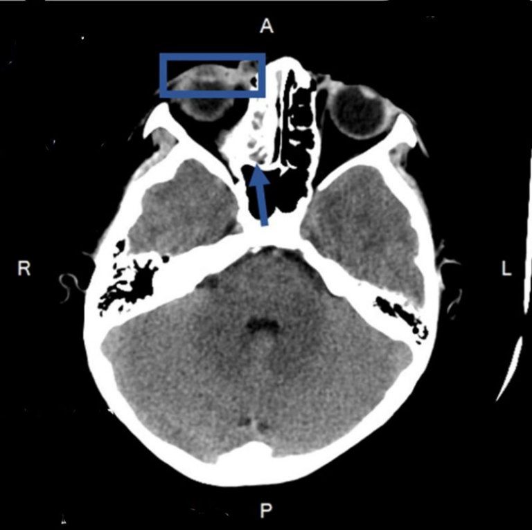 感冒未癒竟併發嚴重感染! 9歲童緊急治療恢復健康 感冒未癒竟併發嚴重感染! 9歲童緊急治療恢復健康