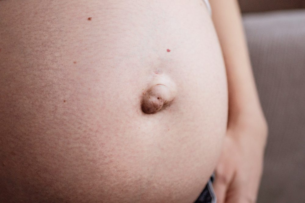 肚臍也會得疝氣?!　醫提醒：臍疝氣應及早評估手術治療