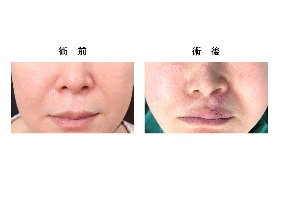 曹賜斌醫師獨創白疤再生術 助患者揮別童年傷痕回歸正常生活 曹賜斌醫師獨創白疤再生術 助患者揮別童年傷痕回歸正常生活