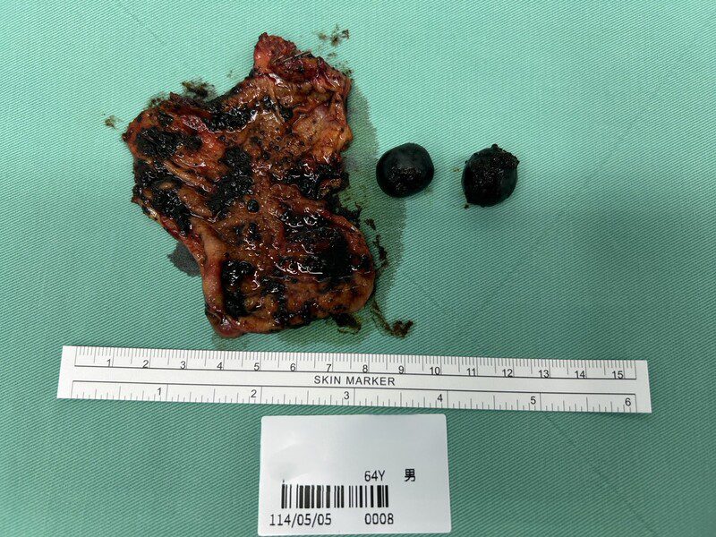 膽結石真會引發膽囊癌！ 全球罕見0.5%癌變機率發生在高雄男身上