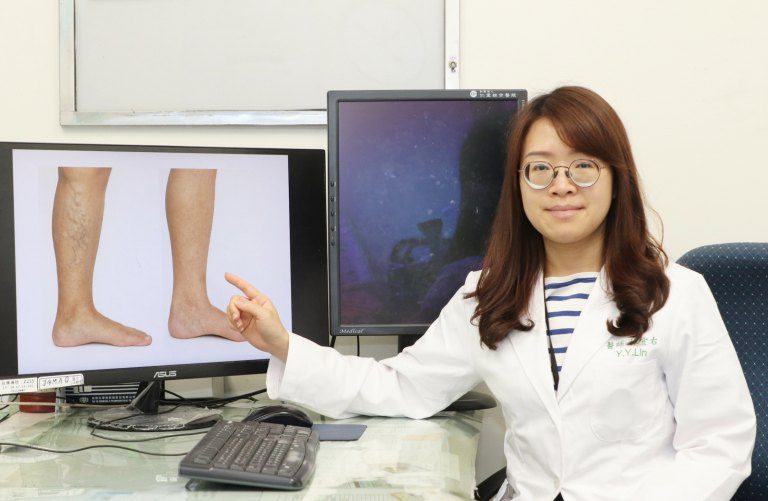 久站造成雙腿腫脹 仁愛長庚醫靜脈曲張微創手術助重返輕盈步伐 久站造成雙腿腫脹 仁愛長庚醫靜脈曲張微創手術助重返輕盈步伐