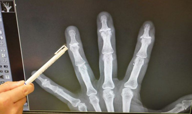 手部退化性關節炎是中老年手指關節變形常見原因 曾能祥醫師:適當手部運動是必須 手部退化性關節炎是中老年手指關節變形常見原因 曾能祥醫師:適當手部運動是必須