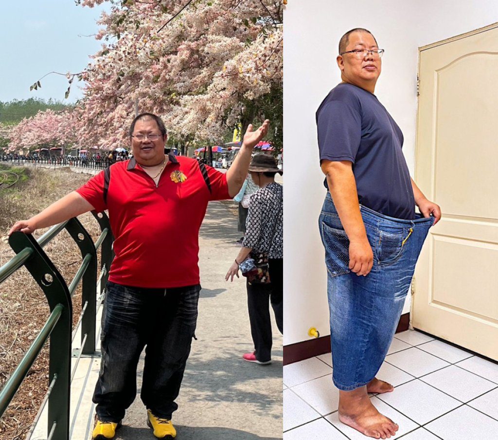 43歲男子術後三個月甩36公斤 中醫大附醫雨果機器手臂助重度肥胖者找回自信 43歲男子術後三個月甩36公斤 中醫大附醫雨果機器手臂助重度肥胖者找回自信