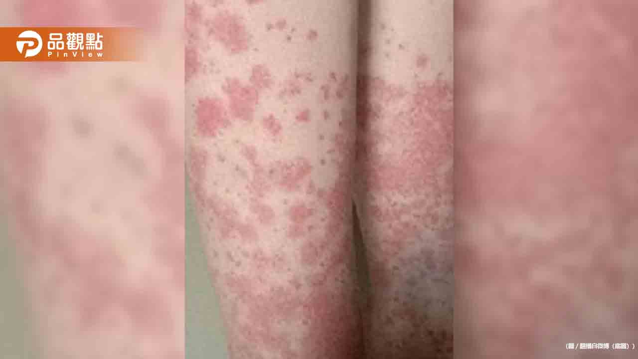 20歲女大生狂染髮「全身爆紫斑」險喪命 20歲女大生狂染髮「全身爆紫斑」險喪命