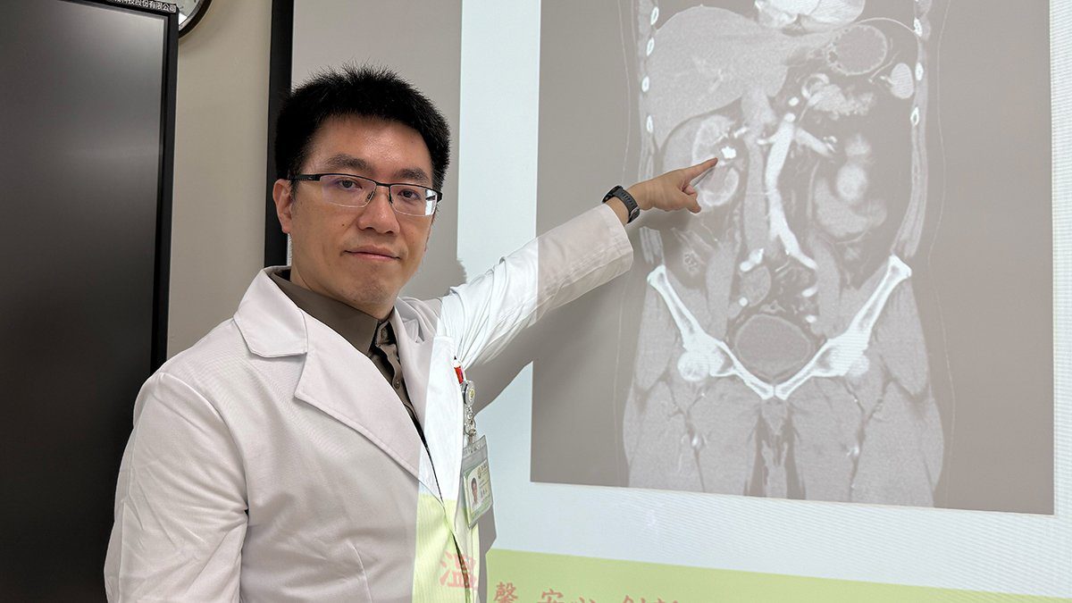 台中61歲男連三年腎結石　醫籲夏季多喝水防復發