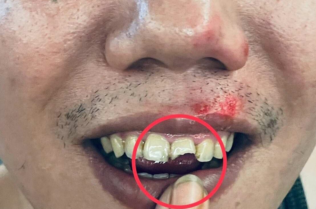 桃園大廟前纜線外露變陷阱!男慘摔斷門牙腦震盪 桃園大廟前纜線外露變陷阱!男慘摔斷門牙腦震盪