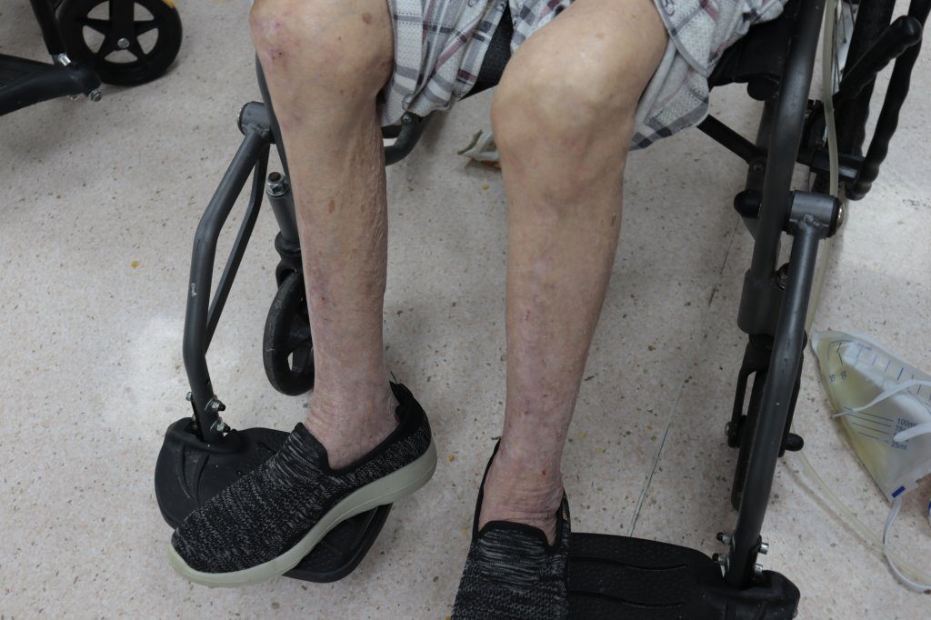 老年人走路無力易跌倒,常誤為骨鬆,部立彰化醫院提醒可能肌少症惹的禍 老年人走路無力易跌倒,常誤為骨鬆,部立彰化醫院提醒可能肌少症惹的禍