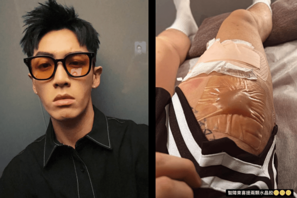 柯震東驚傳腿部燙傷　水泡如「水晶餃」畫面怵目驚心