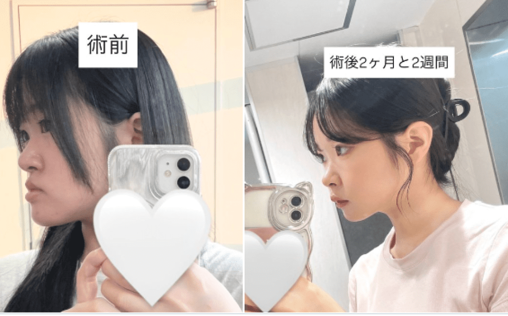 櫻花妹顎骨異常!自PO手術前後對比照「親和力加三成」 網友驚呆:太可愛了 櫻花妹顎骨異常!自PO手術前後對比照「親和力加三成」 網友驚呆:太可愛了