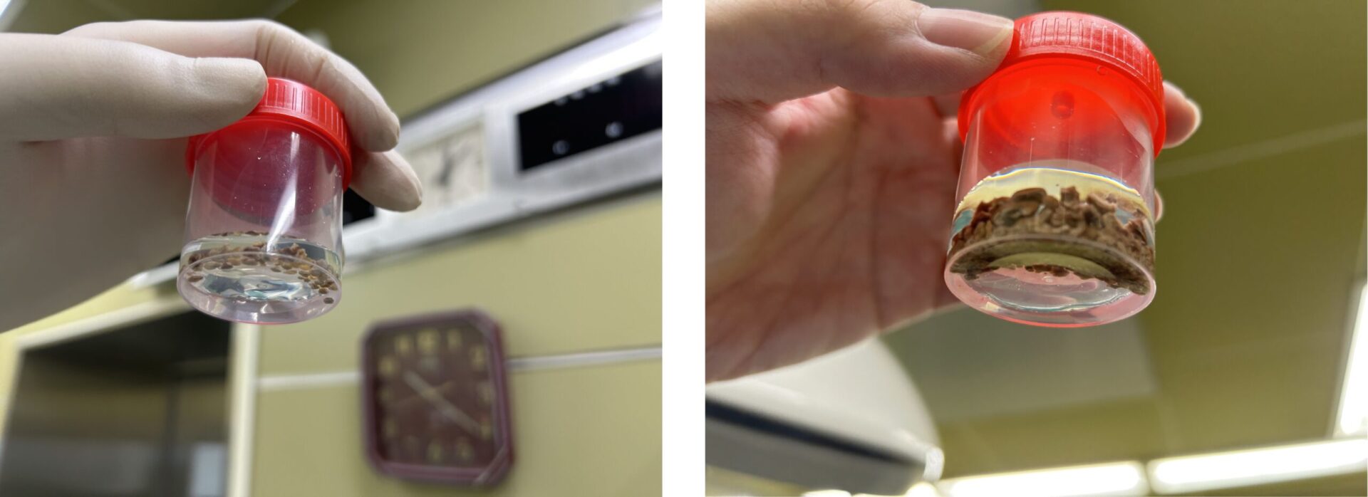 炎炎夏日　小心泌尿結石來敲門