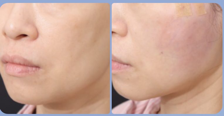 港女臉頰凹凸不平來台就醫 自體脂肪注射年輕化術回春圓夢