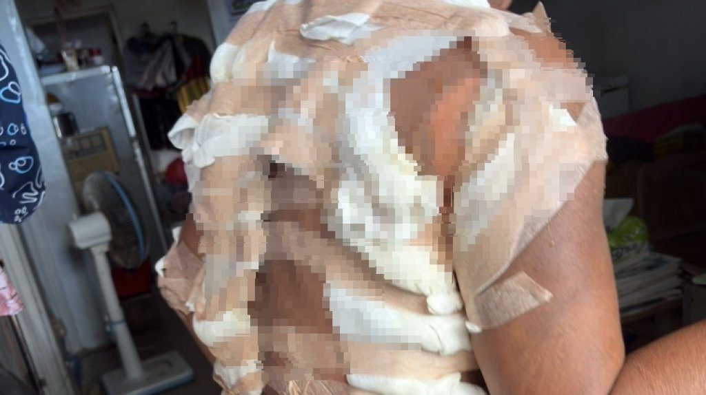 驚悚慎入!台東蘭嶼男子遭潑熱水 背部嚴重燒燙傷轉送台中就醫 驚悚慎入!台東蘭嶼男子遭潑熱水 背部嚴重燒燙傷轉送台中就醫