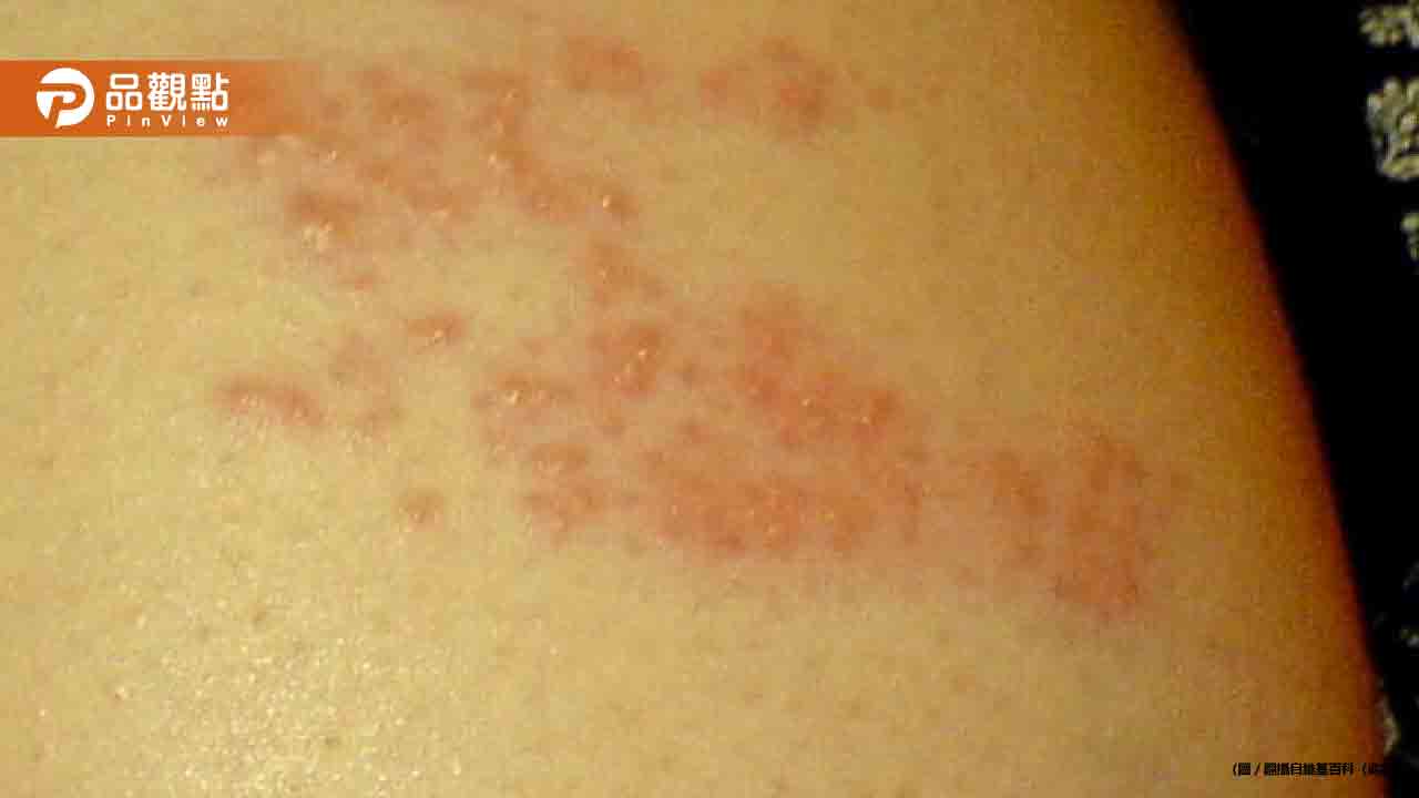 皮蛇肆虐!中高齡患者激增 醫揭傳染高峰期 皮蛇肆虐!中高齡患者激增 醫揭傳染高峰期