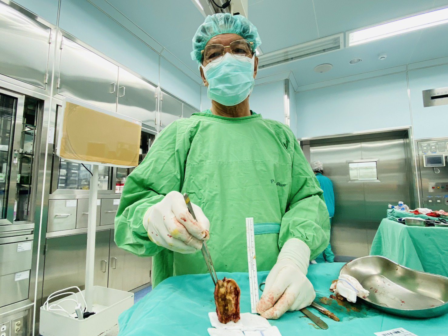 膽囊鈣化成石  罕見陶瓷膽囊現身！博田國際醫院妙手回春