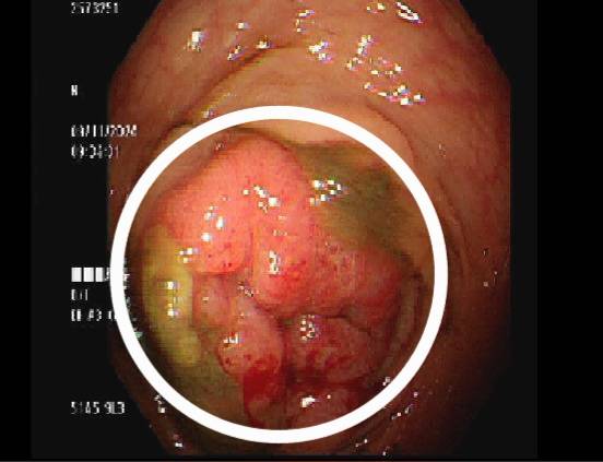 阮綜合醫院提醒:患者勿忽視腹脹腹痛排便異常 阮綜合醫院提醒:患者勿忽視腹脹腹痛排便異常