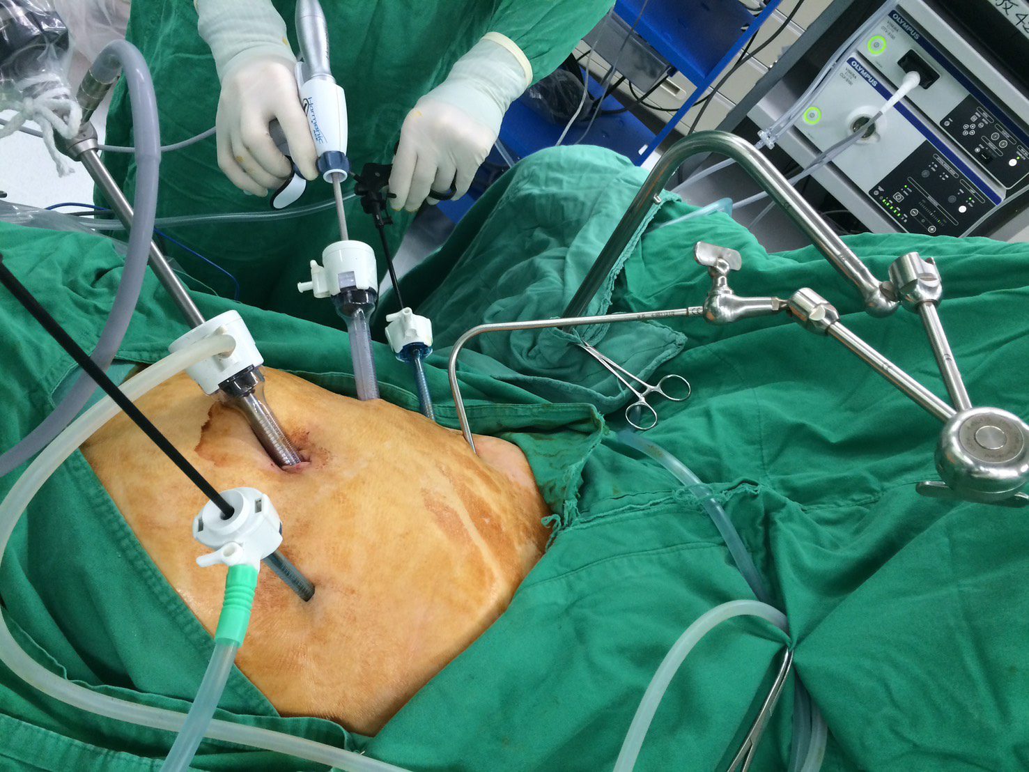 精準診斷揪出胃癌 高雄市立大同醫院成功完成高齡胃癌病患微創全胃切除手術 精準診斷揪出胃癌 高雄市立大同醫院成功完成高齡胃癌病患微創全胃切除手術