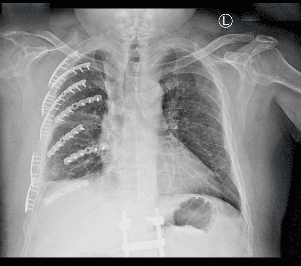 工人國道下車撿拾掉落物遭遊覽車撞斷肋骨 部彰重建治療救回一命 工人國道下車撿拾掉落物遭遊覽車撞斷肋骨 部彰重建治療救回一命