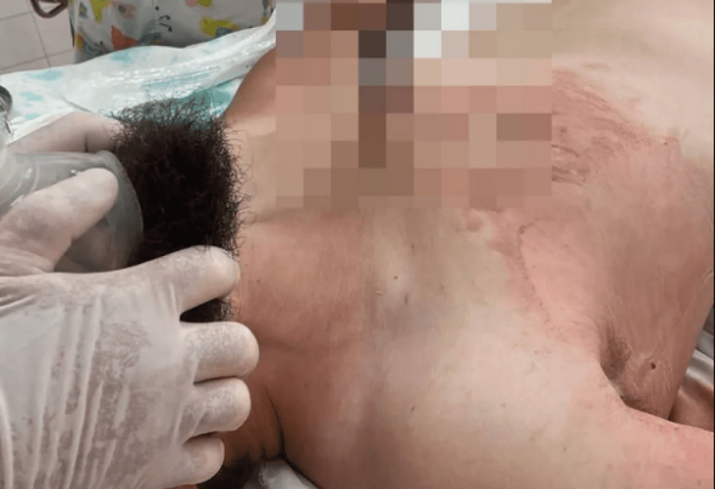 俄羅斯建築工人失足摔落!胸口「被鋼筋刺穿」離心臟僅幾公分 手術後奇蹟生還 俄羅斯建築工人失足摔落!胸口「被鋼筋刺穿」離心臟僅幾公分 手術後奇蹟生還