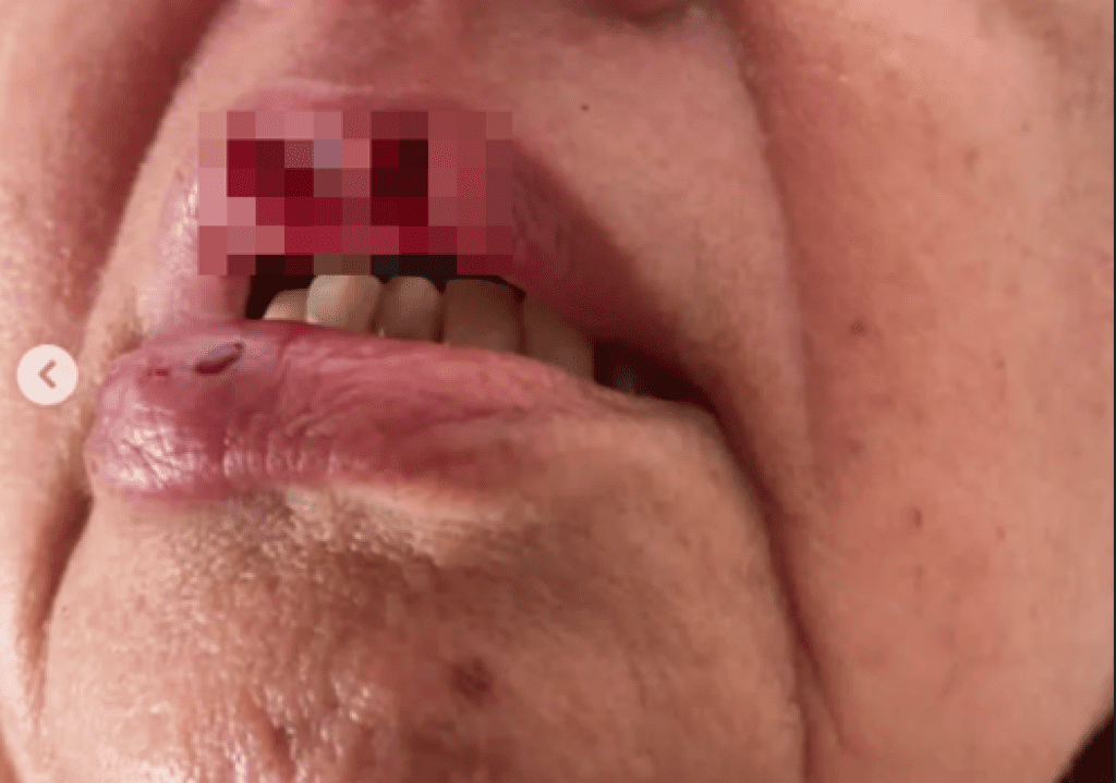 影／女親吻比特犬出事　來不及閃「嘴唇慘被一口啃」變大凹洞