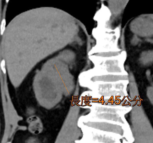 七旬老翁紅尿數月「不痛不理」 頭暈就醫竟然已罹癌 七旬老翁紅尿數月「不痛不理」 頭暈就醫竟然已罹癌