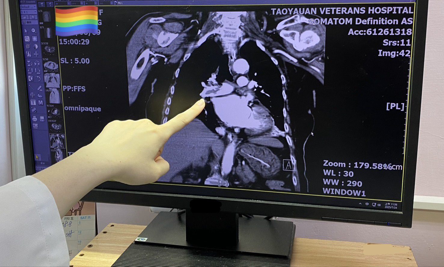 高齡族群當心!肺動脈栓塞難察覺 北榮桃分院醫籲注意這些症狀 高齡族群當心!肺動脈栓塞難察覺 北榮桃分院醫籲注意這些症狀