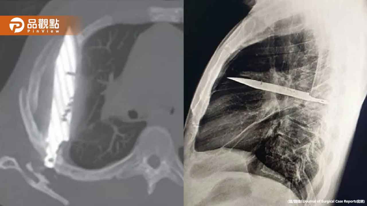 男乳頭痛到流膿！一檢查驚揭「胸腔插把刀8年」