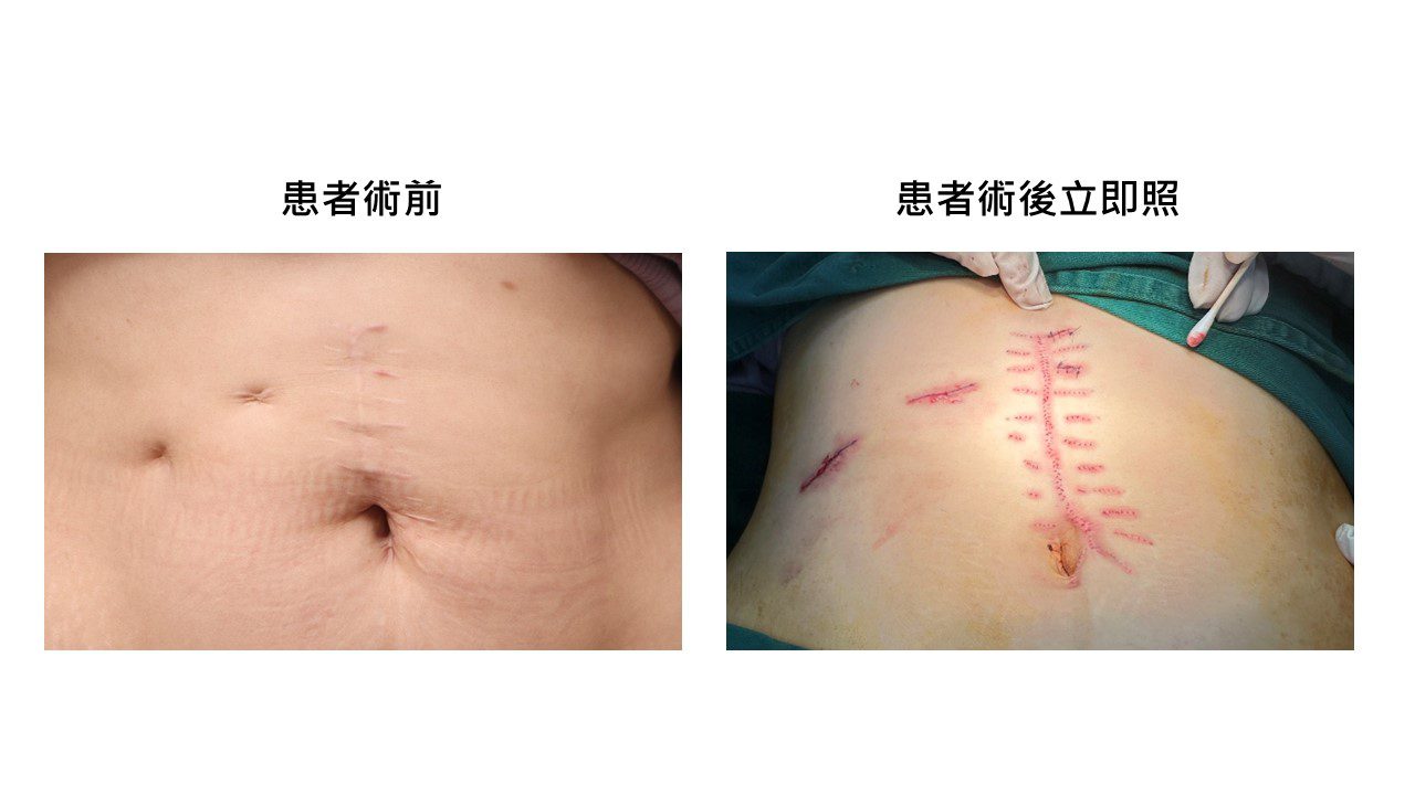 北部婦人腹部20公分「蜈蚣腳」白疤成噩夢 南下求救白疤之父獲救贖 北部婦人腹部20公分「蜈蚣腳」白疤成噩夢 南下求救白疤之父獲救贖